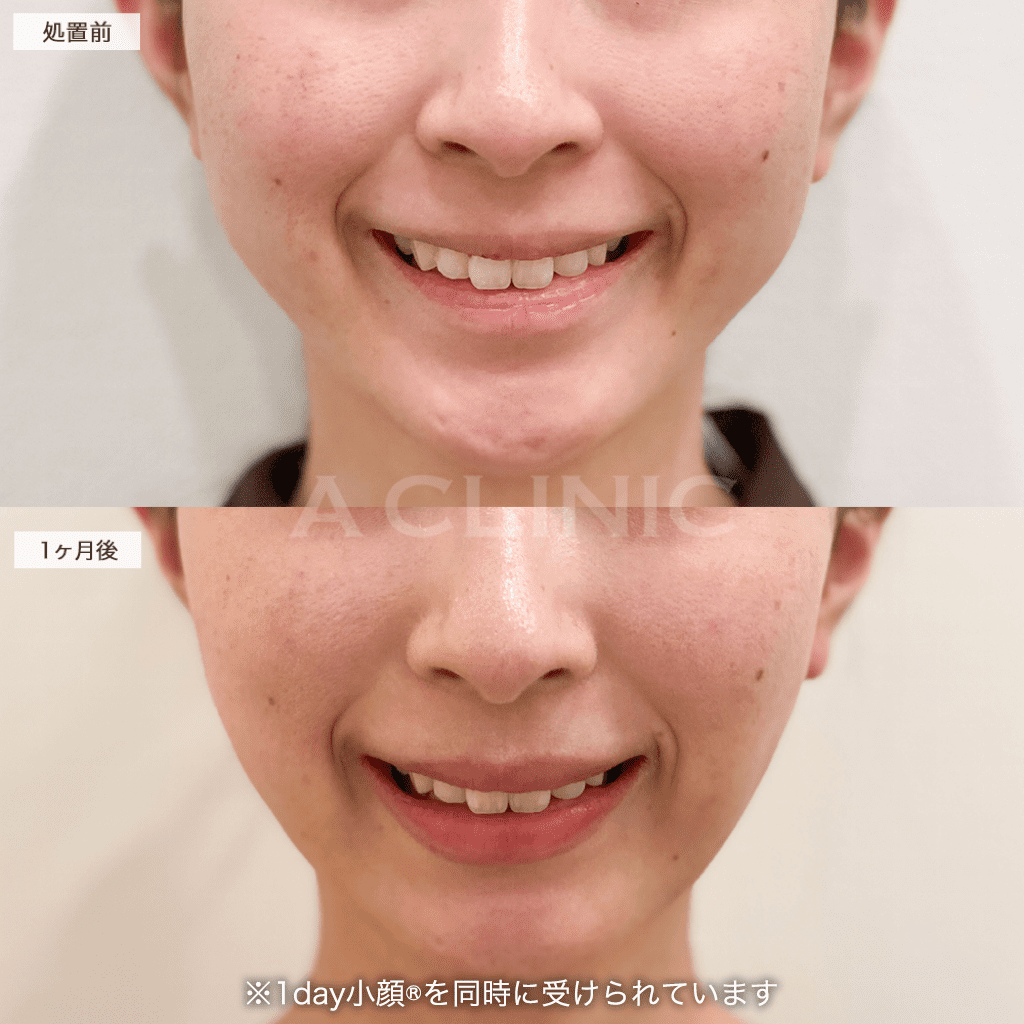 バッカルファット除去術症例写真