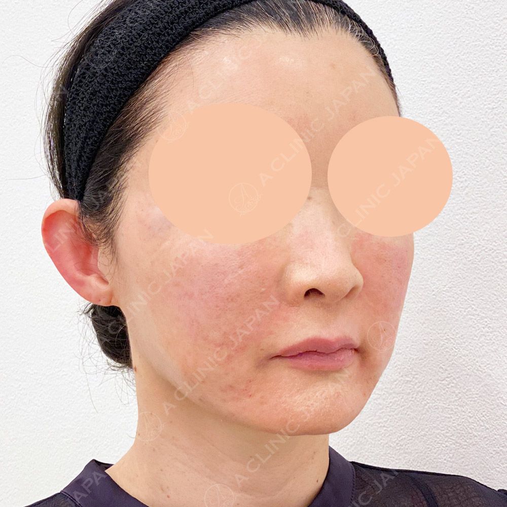ショッピングリフト症例写真2