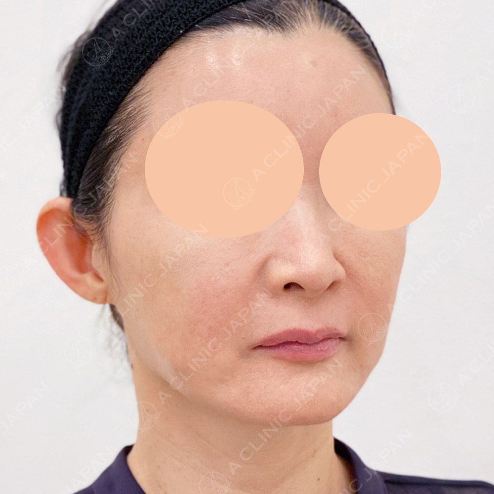 ショッピングリフト症例写真