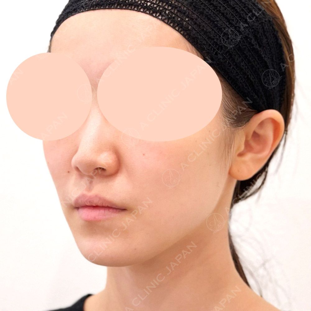 ショッピングリフト症例写真3
