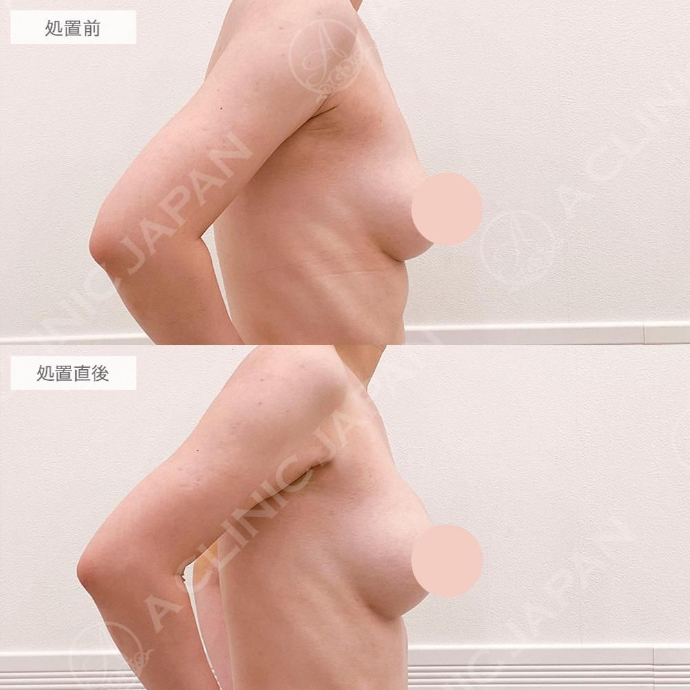 ヒアルロン酸豊胸術の症例写真