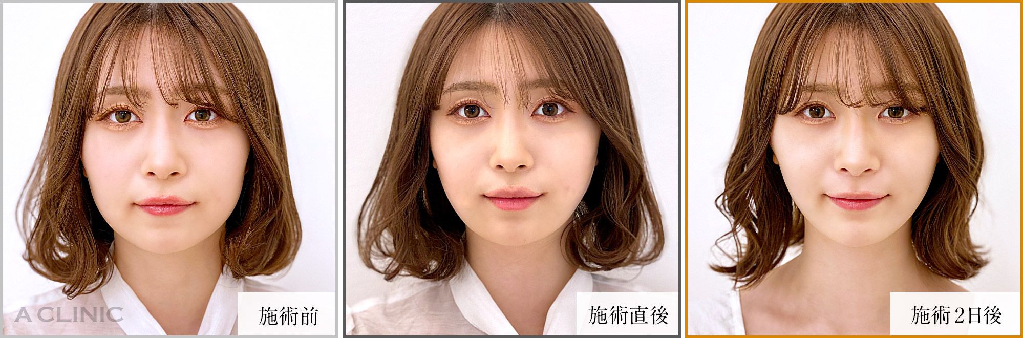 1day小顔症例