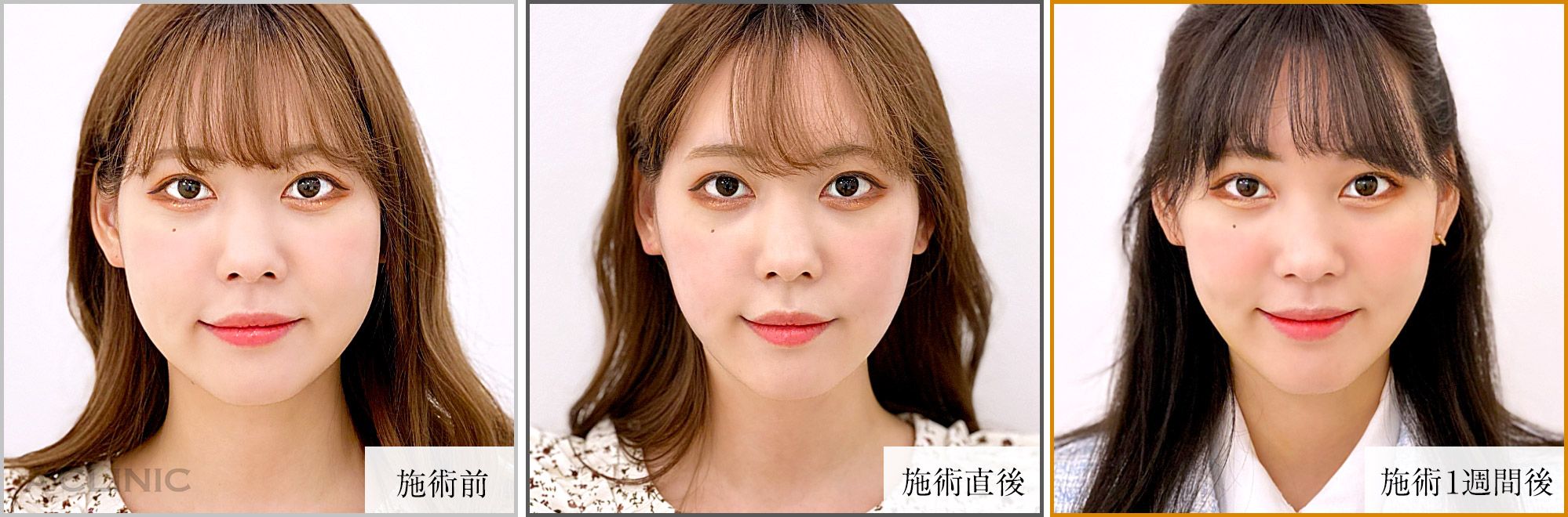 1day小顔症例