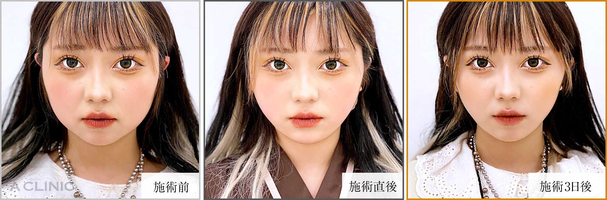 1day小顔症例