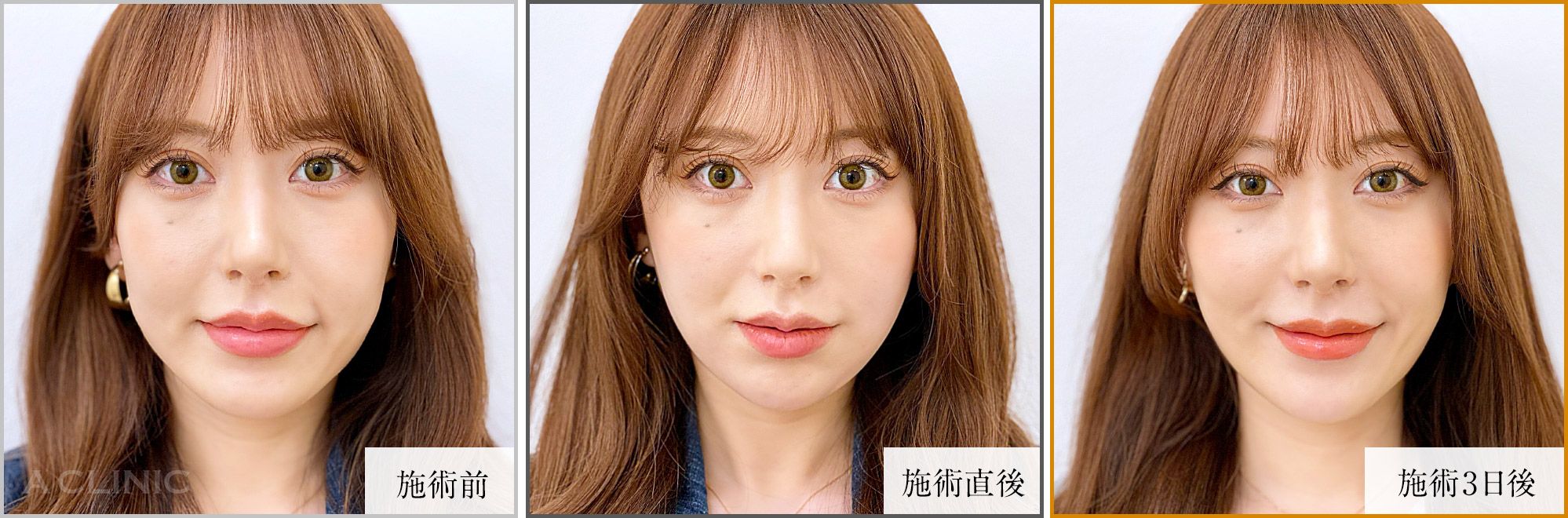 1day小顔症例