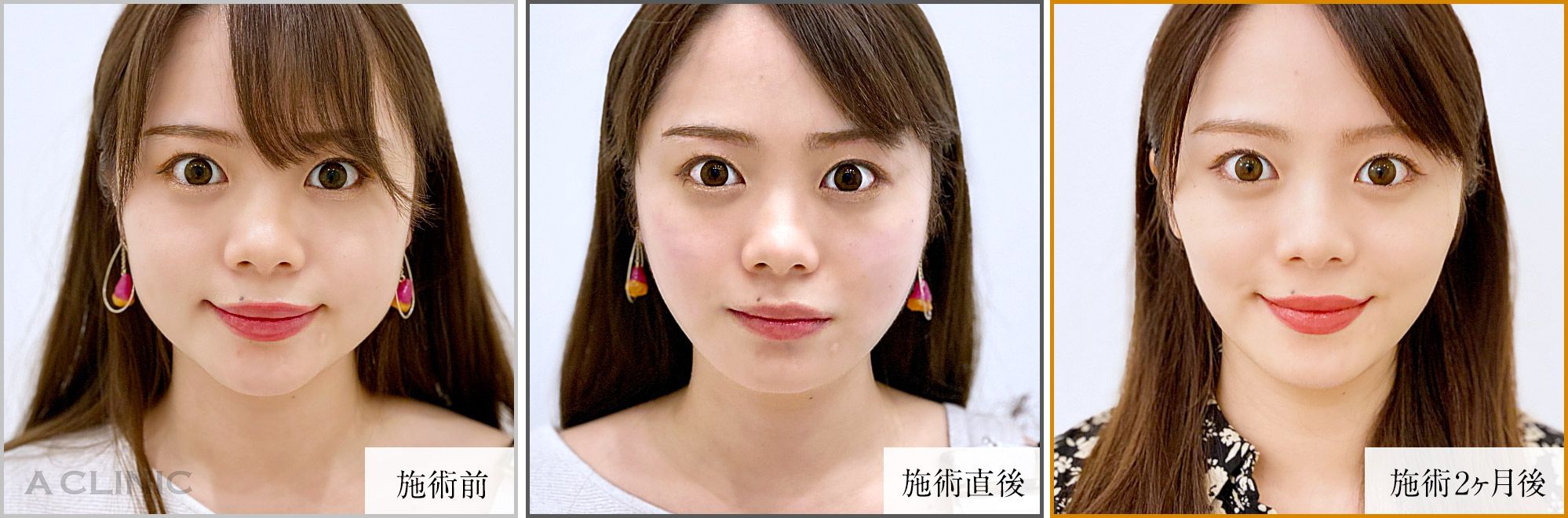 1day小顔症例