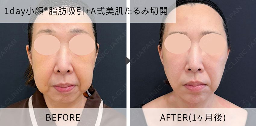 症例写真 1day小顔脂肪吸引+A式美肌たるみ切開