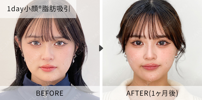 症例写真 1day小顔脂肪吸引