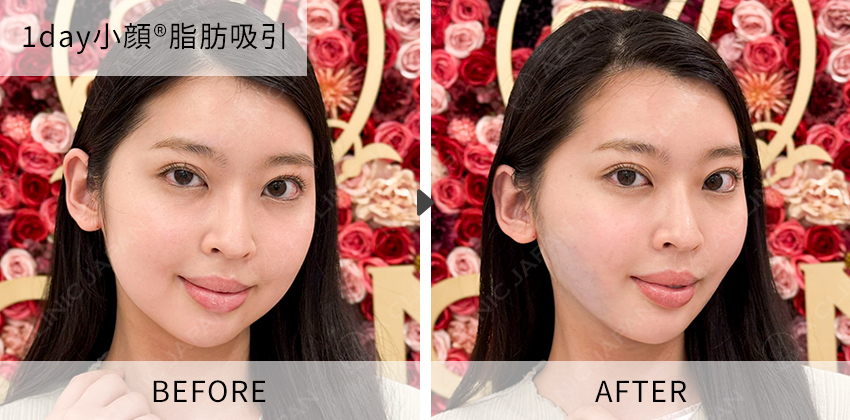 症例写真 1day小顔脂肪吸引