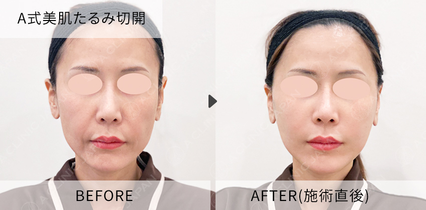 症例写真 耳介軟骨移植(鼻尖形成)