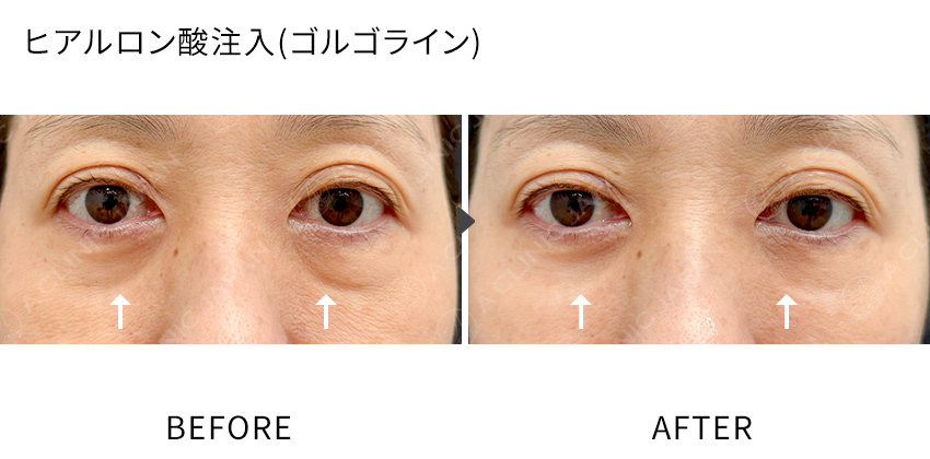 症例写真 ヒアルロン酸注入(ゴルゴライン)