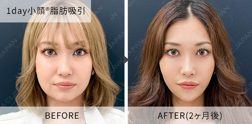 柴田医師の症例写真 1day小顔脂肪吸引