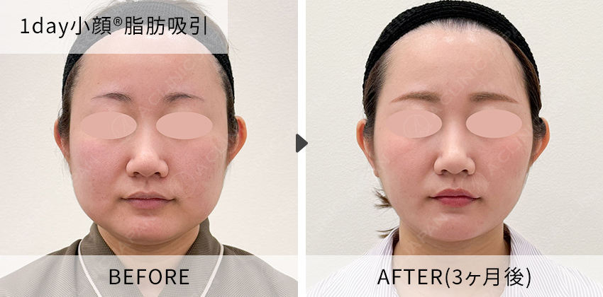 柴田医師の症例写真 1day小顔脂肪吸引