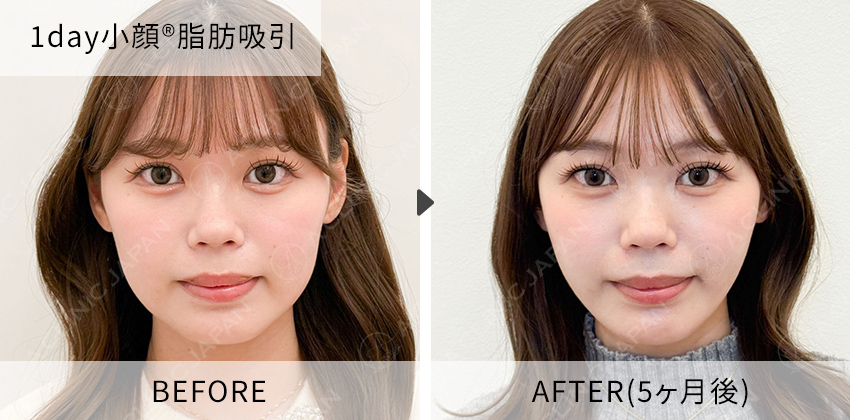 住田医師の症例写真 1day小顔脂肪吸引