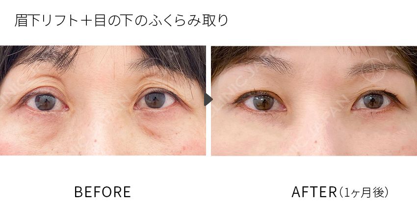 住田医師の症例写真 眉下リフト+目の下のふくらみ取り