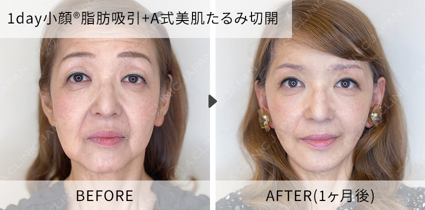 住田医師の症例写真 1day小顔脂肪吸引+A式美肌たるみ切開