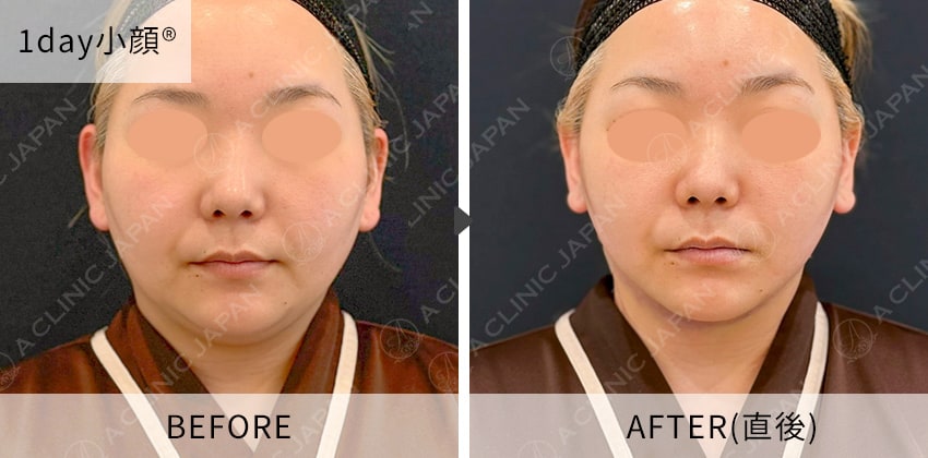 症例写真 1day小顔脂肪吸引