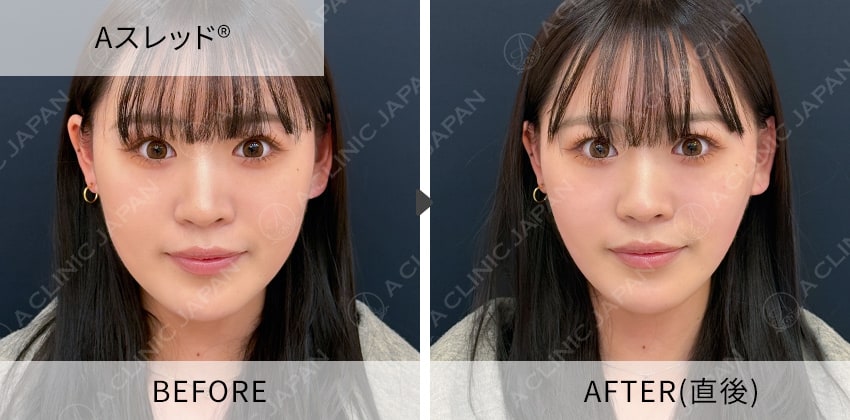症例写真 Aスレッド