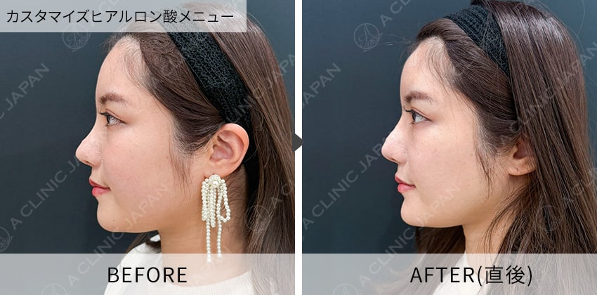 症例写真 ヒアルロン酸注入(あご)