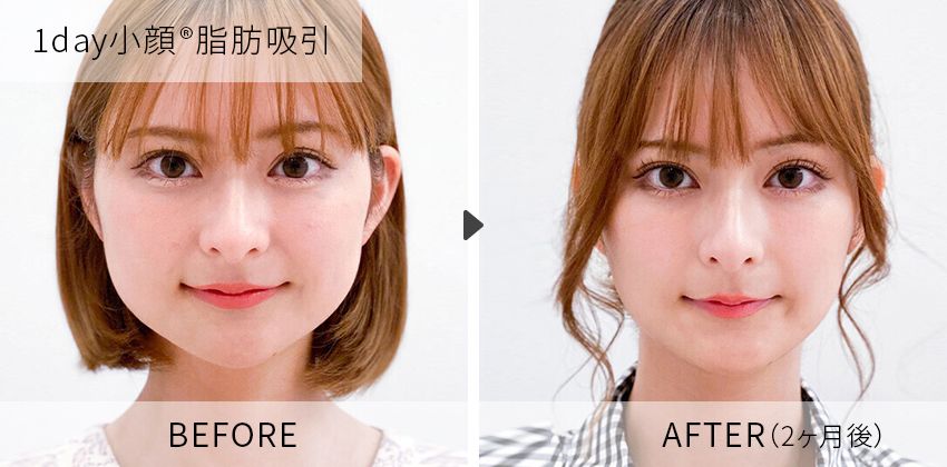田窪医師の症例写真 1day小顔脂肪吸引