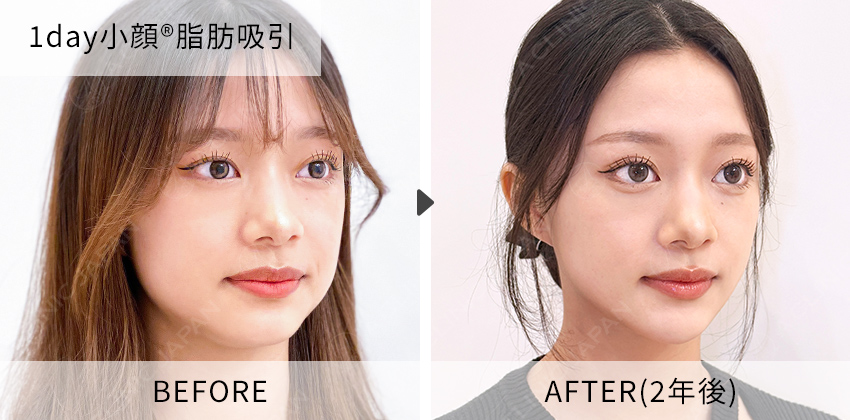 田窪医師の症例写真 1day小顔脂肪吸引