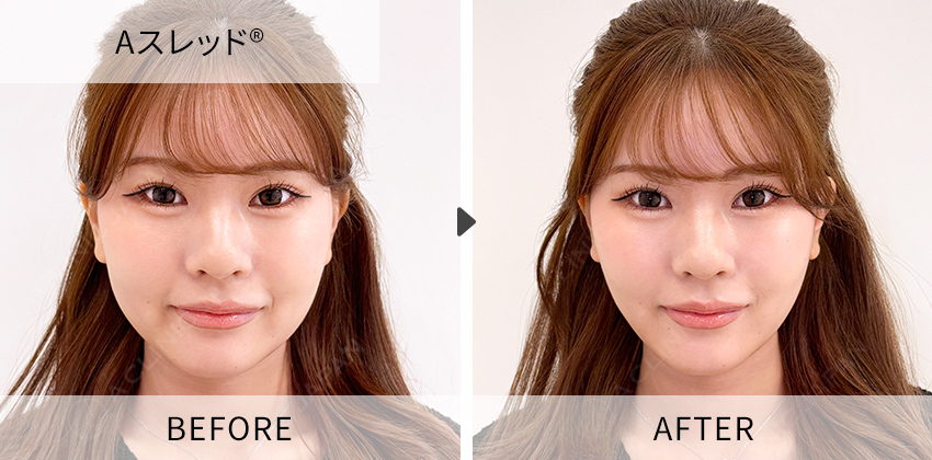 田窪医師の症例写真 Aスレッド®