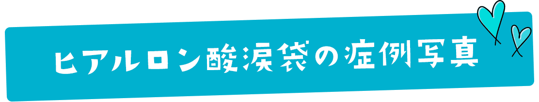 涙袋形成術の症例写真タイトル