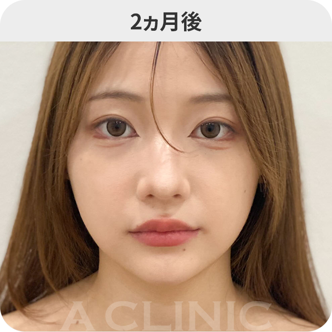 1day小顔®︎ダウンタイムの症例写真