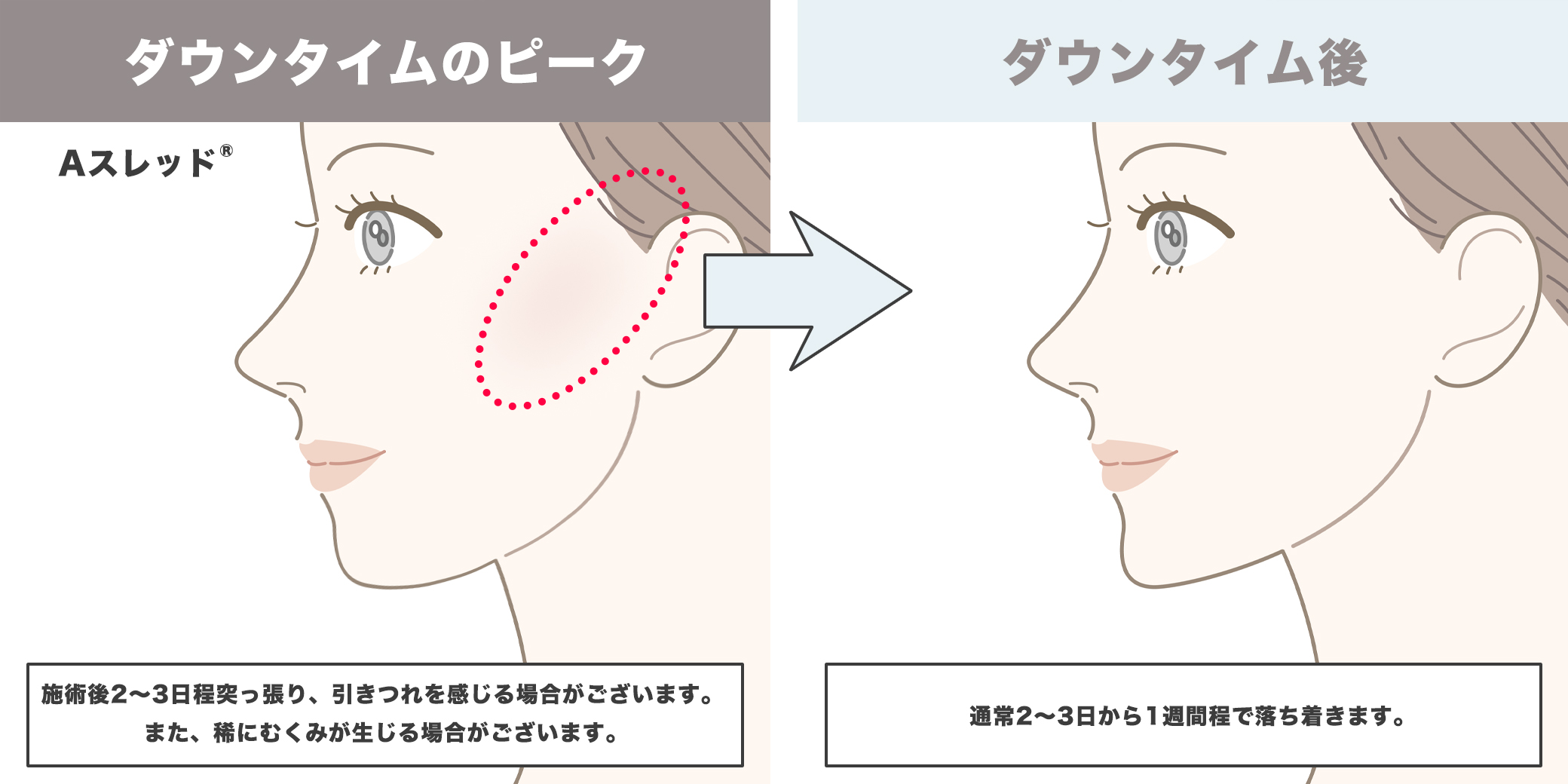Aスレッド®のダウンタイムイラスト