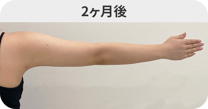 二の腕スリム脂肪吸引ダウンタイムの症例写真