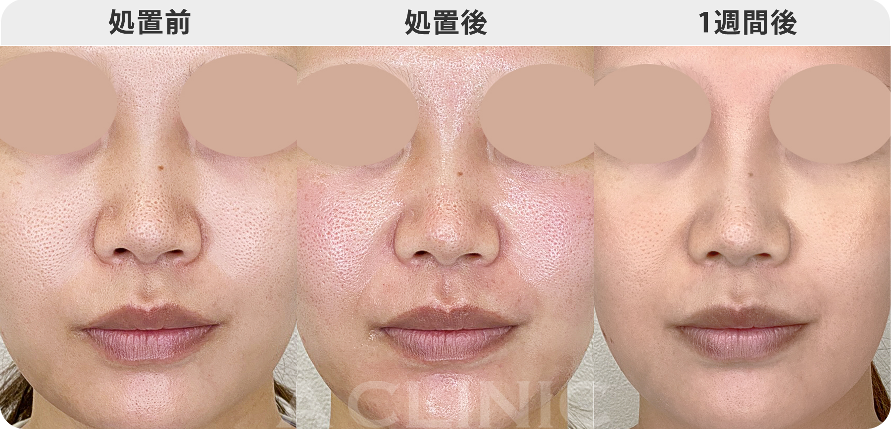 ポテンツァのダウンタイム画像