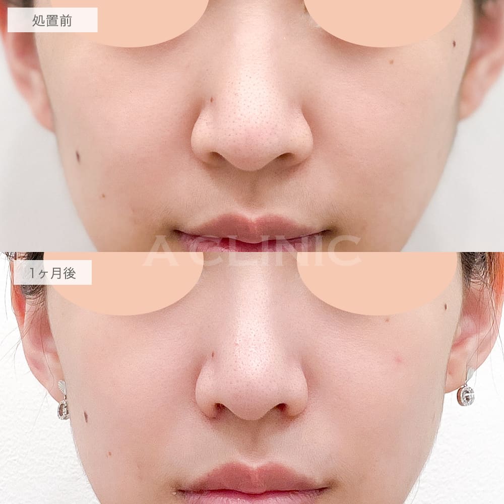 小鼻縮小術切開法症例写真1