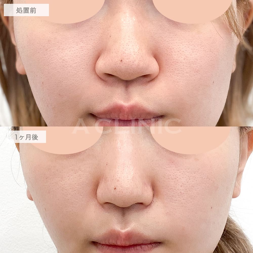 小鼻縮小術切開法症例写真2