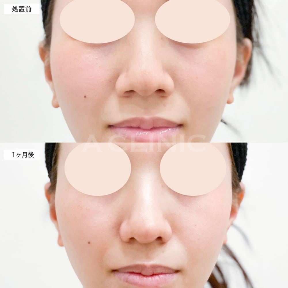 小鼻縮小術切開法症例写真1