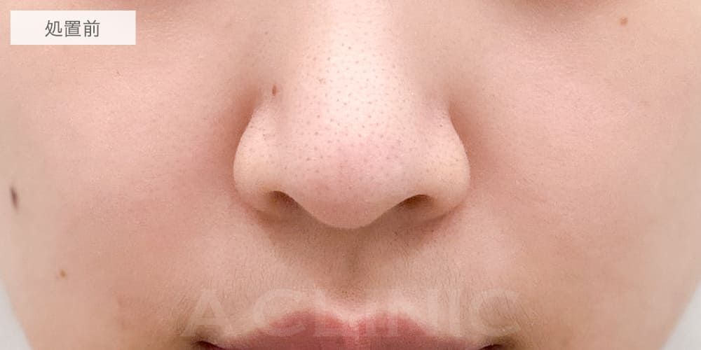 小鼻縮小術切開法症例写真4