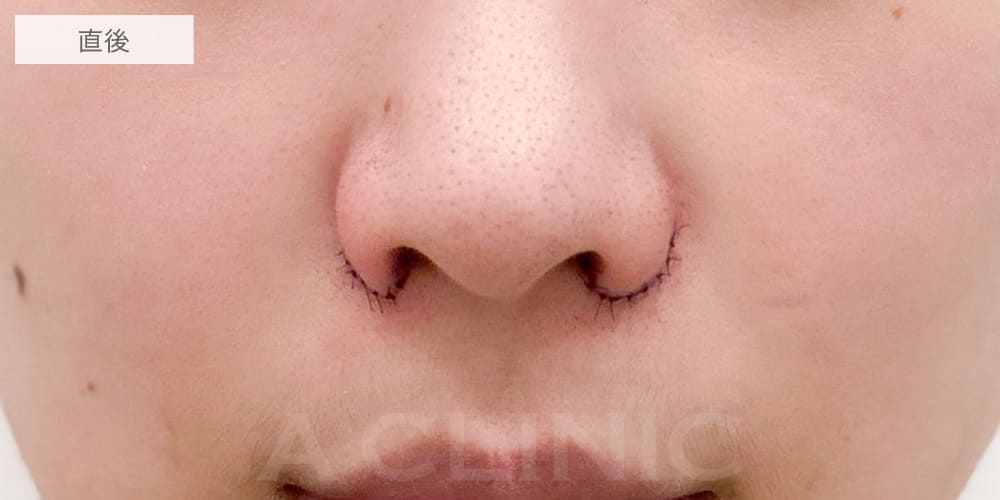 小鼻縮小術切開法症例写真5