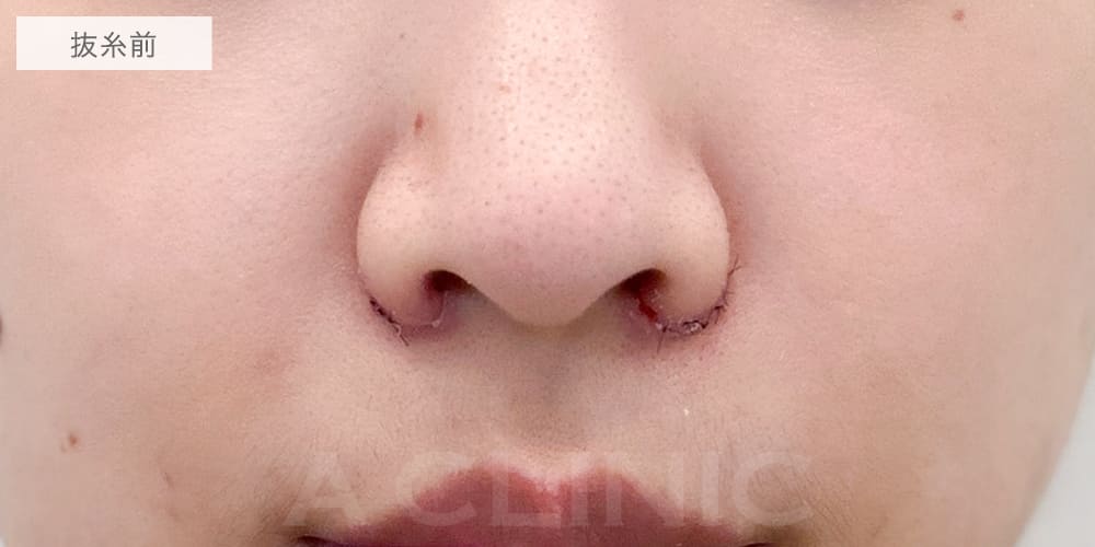小鼻縮小術切開法症例写真6