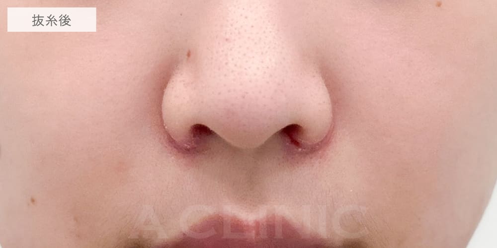 小鼻縮小術切開法症例写真7