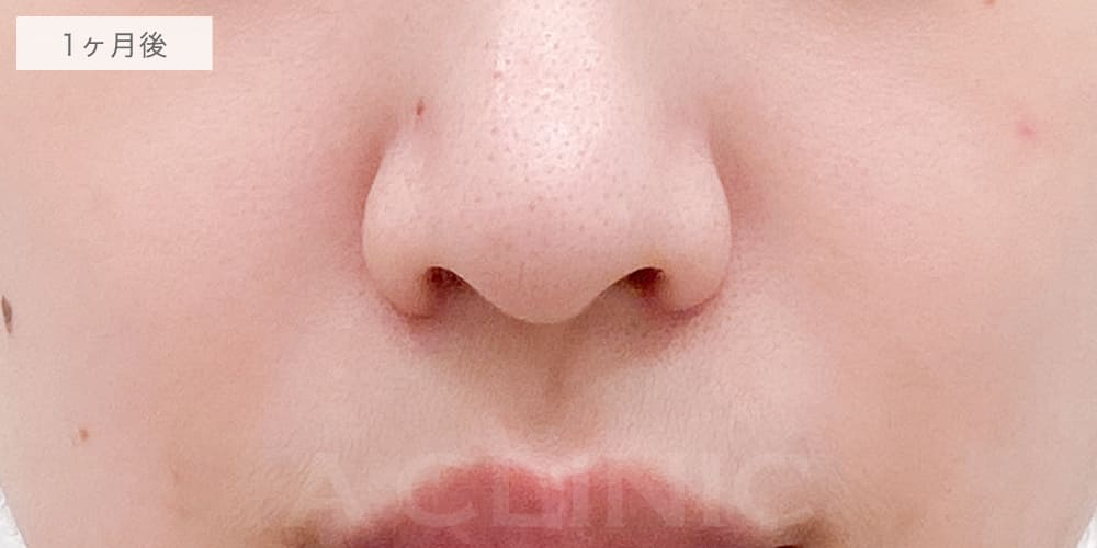 小鼻縮小術切開法症例写真8