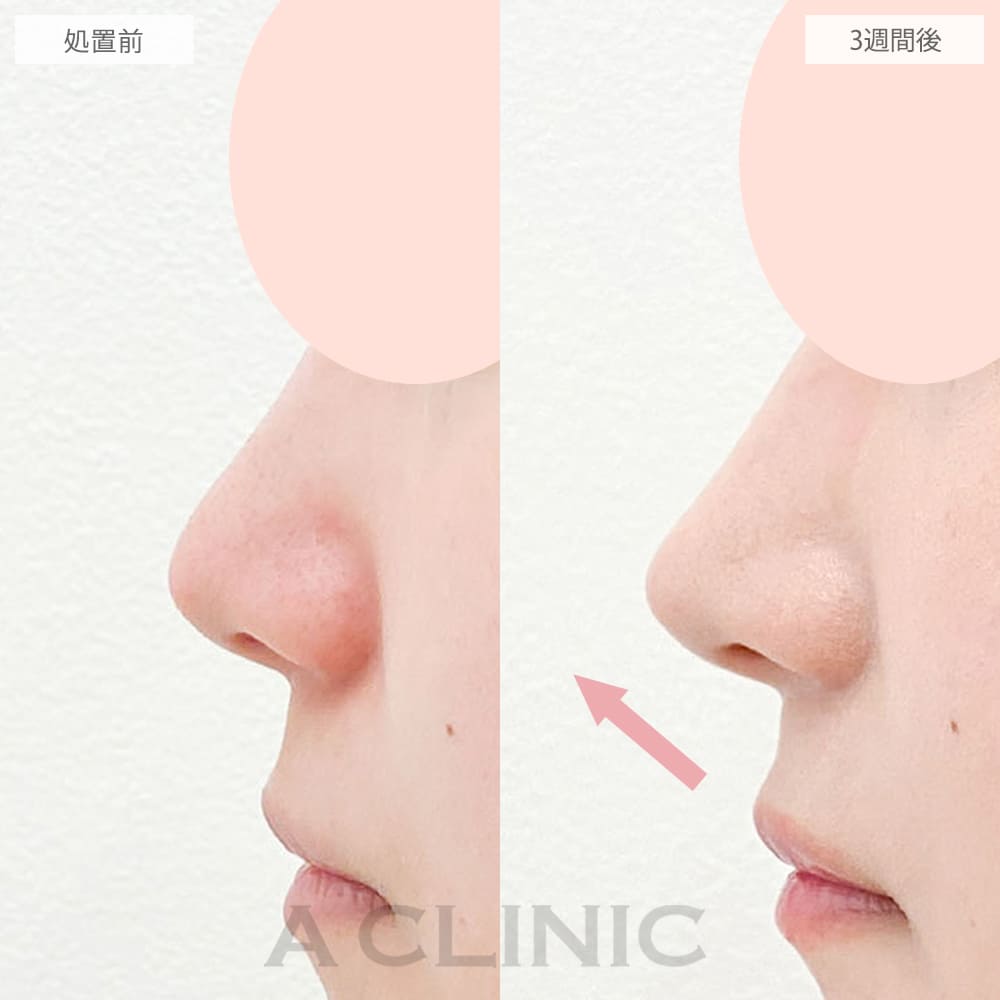 鼻尖形成（耳介軟骨・耳珠軟骨移植）の症例写真1