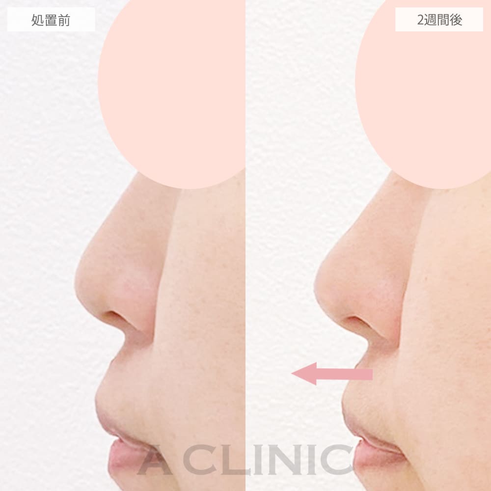 鼻尖形成（耳介軟骨・耳珠軟骨移植）の症例写真2