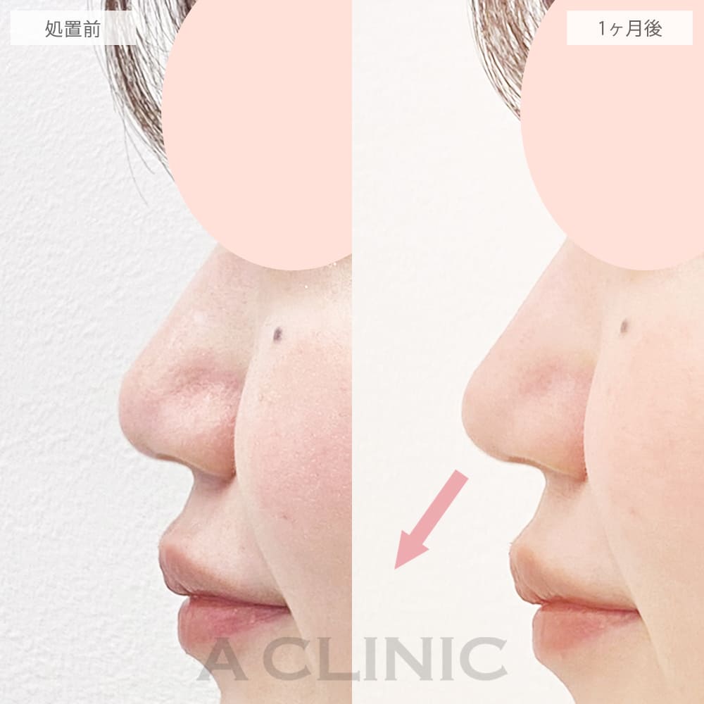 鼻尖形成（耳介軟骨・耳珠軟骨移植）の症例写真3