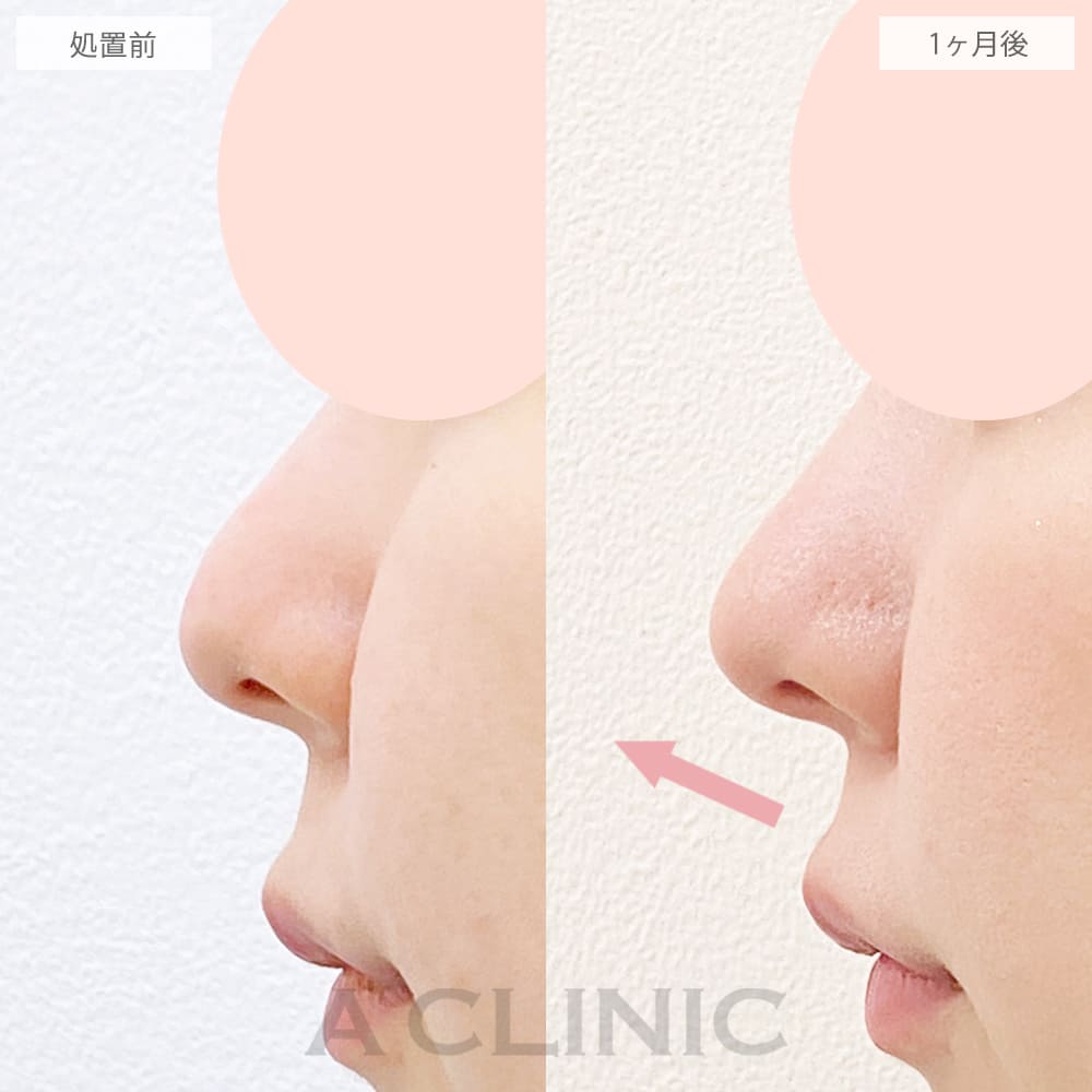 鼻尖形成（耳介軟骨・耳珠軟骨移植）の症例写真4