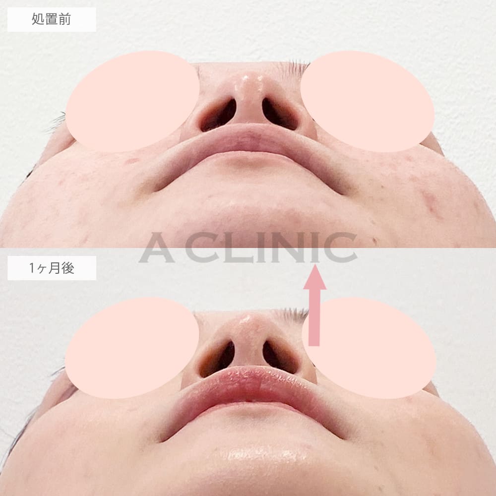 鼻尖形成（耳介軟骨・耳珠軟骨移植）の症例写真5