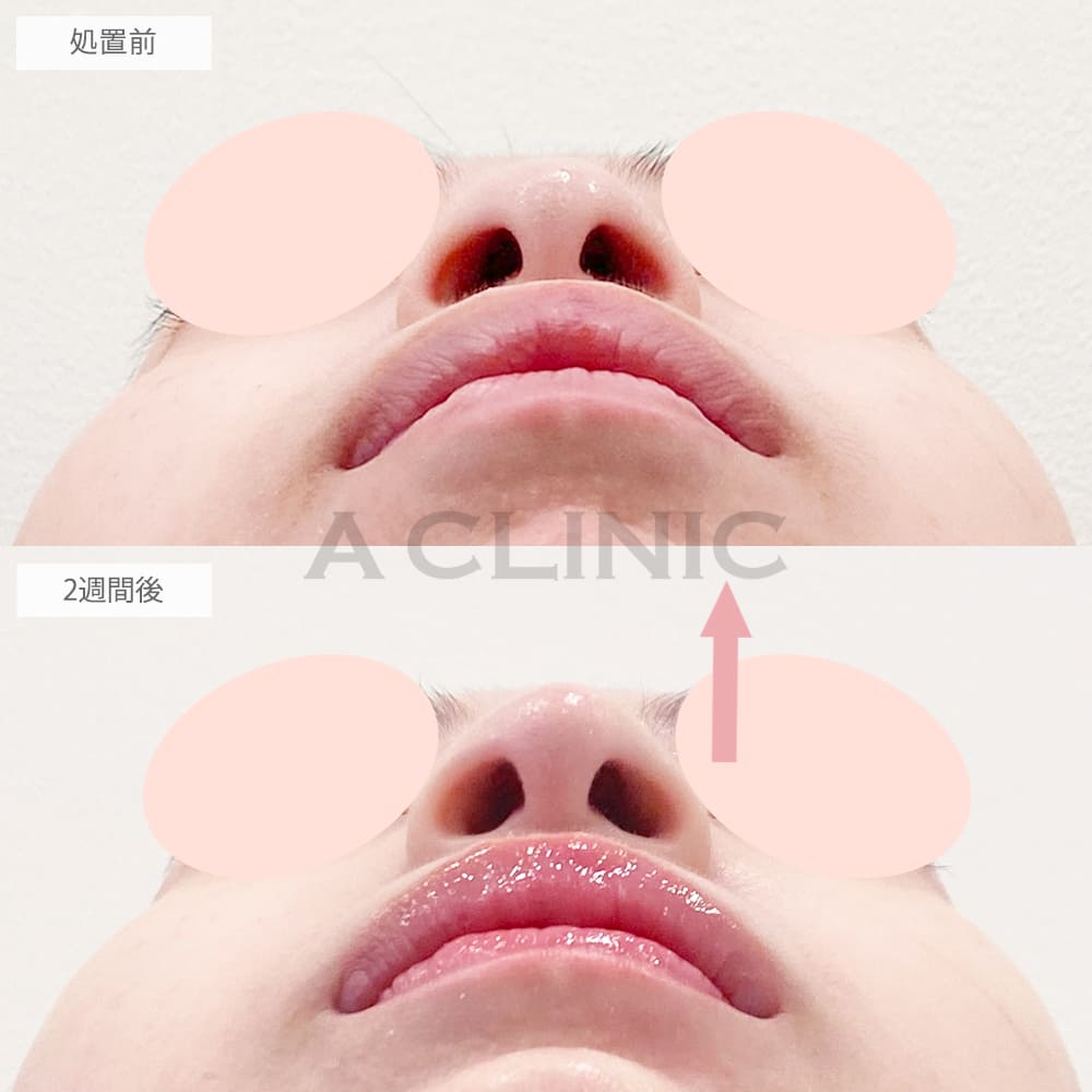 鼻尖形成（耳介軟骨・耳珠軟骨移植）の症例写真6