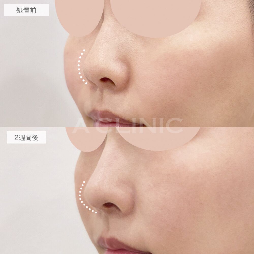 鼻尖形成（耳介軟骨・耳珠軟骨移植）の症例写真7