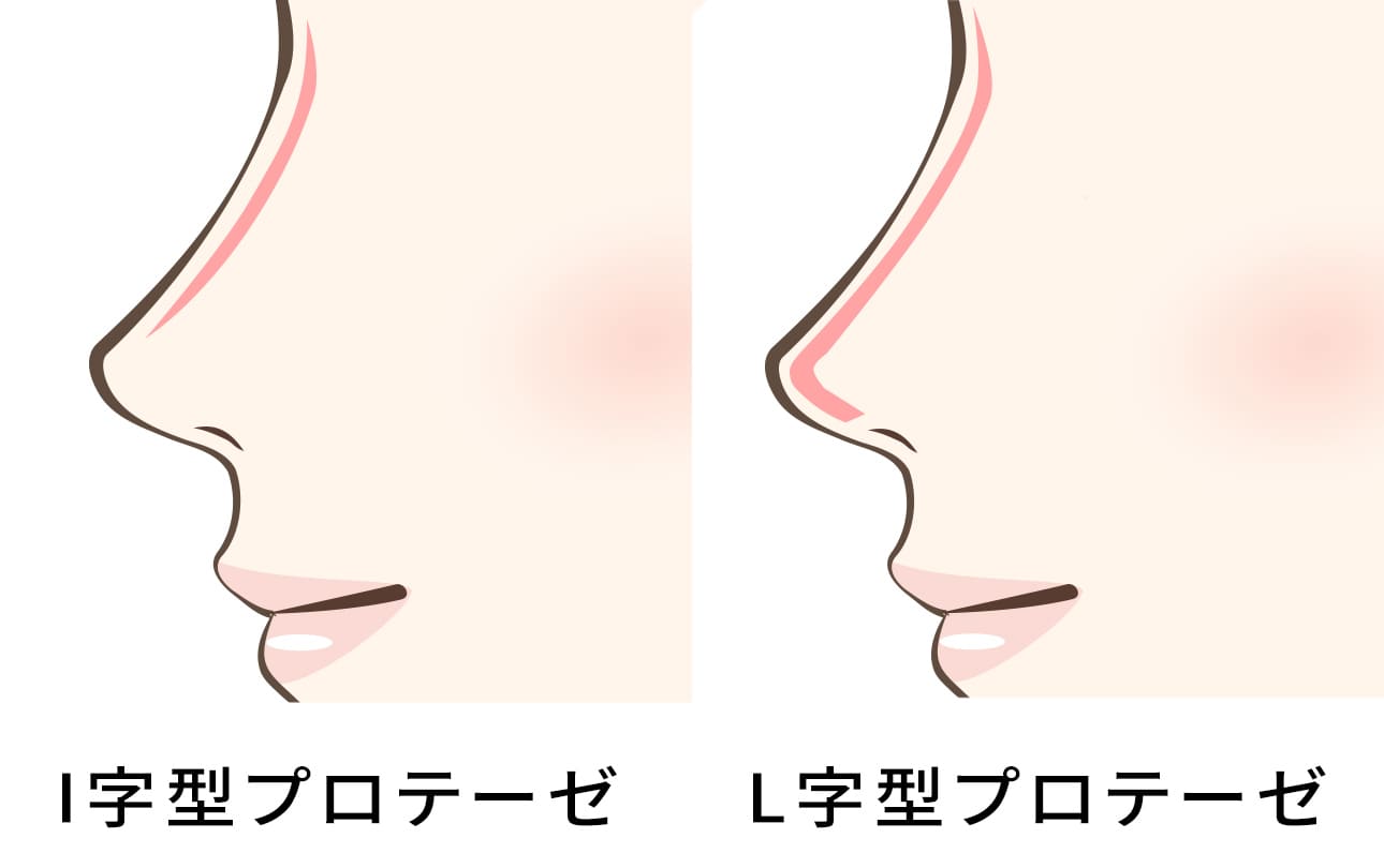 I字型のプロテーゼ、L字型のプロテーゼ