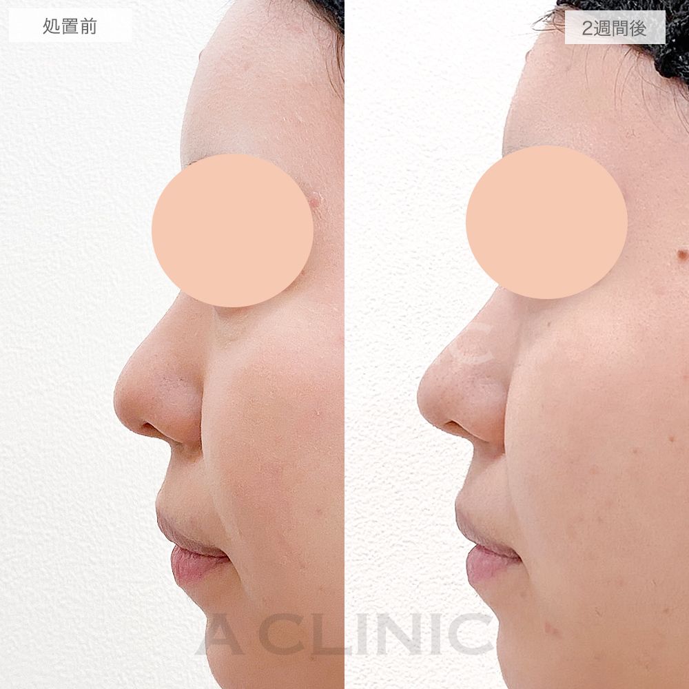 鼻先縮小術切開法症例写真1