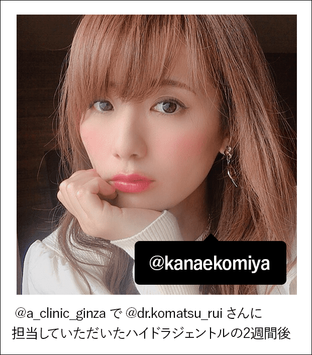 @a_clinic_ginza で @dr.komatsu_rui さんに担当していただいたハイドラジェントルの2週間後