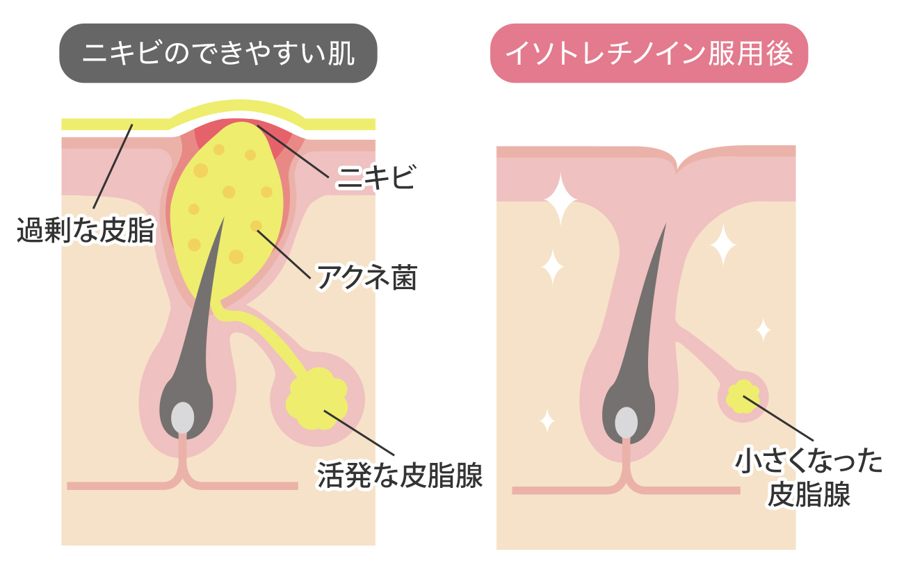 イソトレチノイン